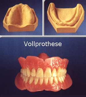 Vollprothese